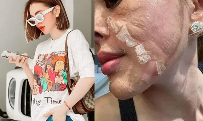 Hotgirl tự peel da tại nhà, da bong mảng như rắn lột, đẹp thì ít, hại thì nhiều