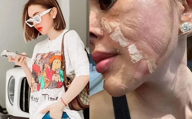 Hotgirl tự peel da tại nhà, da bong mảng như rắn lột, đẹp thì ít, hại thì nhiều