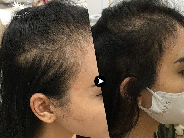 Hơn 100 ảnh về cấy tóc ở việt nam  NEC
