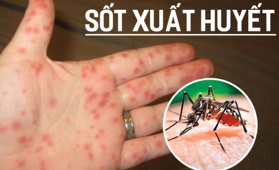 sot-xuat-huyet-nguyen-nhan-trieu-chung-dieu-tri-va-cach-phong-ngua-9c83b631-1781337597.png