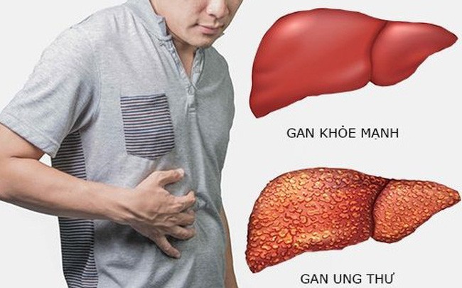 ung-thu-gan-17174950269901351234752-1782268647.webp