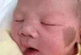 Bé sơ sinh chào đời có vết bớt trên mặt, bác sĩ: Có thể do đã xảy ra những tình huống này trong thai kỳ