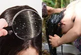 Gội đầu liên tục mà gàu vẫn tróc từng mảng, thử áp dụng những công thức tự nhiên này bạn sẽ sớm ngừng gãi