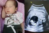 Người phụ nữ mang thai đôi nhưng lúc sinh chỉ 1 em bé ra đời, bác sĩ phát hiện điều hiếm gặp