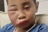 Vừa nghỉ hè cuối tuần về chơi với ông bà ở quê, bé trai khiến mẹ phát hoảng với gương mặt biến dạng