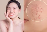 Da dễ sạm, đổ dầu và nổi mụn mùa Hè? Đây là những cách giúp làn da sáng khỏe hơn mỗi ngày