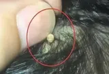 Bà nội vô tình thấy vật thể lạ bằng hạt gạo dính chặt trên đầu cháu gái, đưa đi khám bác sĩ thở phào