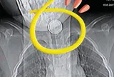Cháu nuốt nhầm pin cúc áo, bà nội cố gắng gây nôn nhưng mẹ đứa trẻ cản, BS khen: Chị rất thông minh!