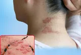 Kiến ba khoang "vào mùa" khiến cuộc sống người dân bị đảo lộn, nhiều người nhầm lẫn với zona thần kinh