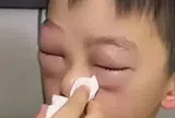 Mẹ hốt hoảng vì mắt con sưng to như quả trứng gà, nguyên nhân phía sau ai cũng "dở khóc dở cười"