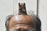 Câu chuyện kỳ lạ về người đàn ông bất ngờ mọc "sừng" dài hơn 10cm trên đầu