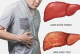 Bác sĩ chỉ ra 8 dấu hiệu cảnh báo ung thư gan sớm không nên bỏ qua