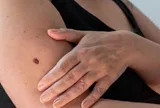 Cứ ngỡ chỉ là dị ứng thời tiết, cô gái trẻ bàng hoàng phát hiện mắc ung thư gan giai đoạn cuối chỉ từ một triệu chứng