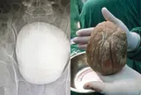 Tiểu ngắt quãng nhiều năm, người đàn ông bất ngờ phát hiện sỏi bàng quang khổng lồ nặng 1,3kg