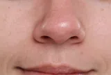 Mụn đầu đen tái đi tái lại dù chăm da kỹ? Nguyên nhân có thể nằm ở những thói quen hằng ngày của bạn