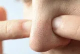 Mụn đầu đen mãi không hết? Có thể bạn vẫn đang mắc 5 thói quen này mỗi ngày