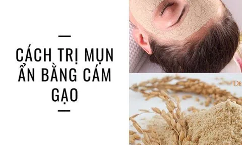 18 Cách trị mụn ẩn tại nhà bằng thiên nhiên an toàn hiệu quả nhất