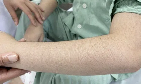 Bé trai Bắc Giang bỗng rậm lông sau một tháng dùng thứ này, BS cảnh báo điều phụ huynh cần tránh