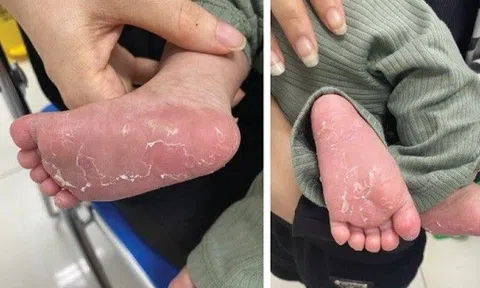 Bé 1,5 tháng tuổi ở Hải Dương mắc giang mai, xét nghiệm bố mẹ mới biết sự thật không ngờ