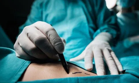 Người phụ nữ 46 tuổi hoại tử bụng sau tiêm tan mỡ, thẩm mỹ viện nói “do còn trinh”