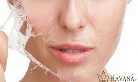 Hậu quả khôn lường khi điều trị nám không đúng cách