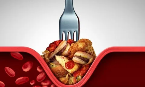 Chuyên gia lý giải vì sao gần 50% người thành thị bị mỡ máu