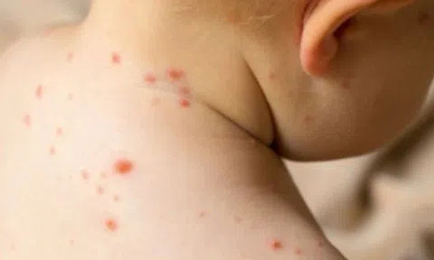 Bệnh đậu mùa khỉ có nguy hiểm không? Mắc bệnh đậu mùa khỉ liệu có dễ chết?