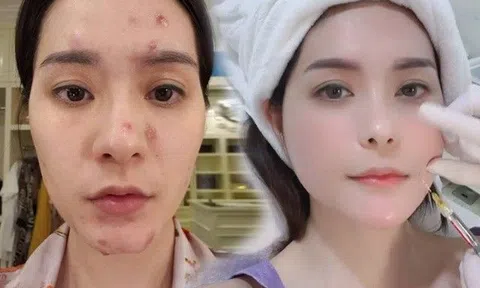 Kim xâu vào da mặt, nữ đại gia Quận 7 vẫn bình thản livestream, khoe trẻ ra chục tuổi