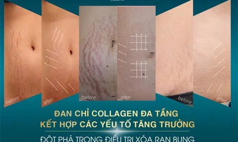Đan chỉ collagen đa tầng kết hợp Plasma tự thân - Đột phá trong điều trị xóa rạn bụng
