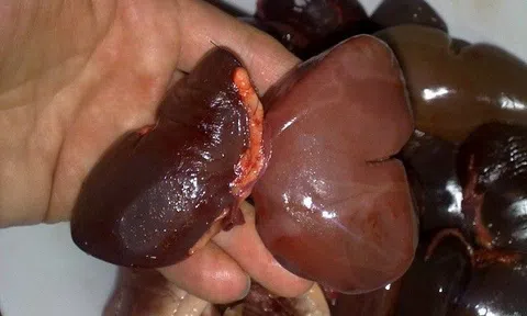 15 loại thực phẩm nên tránh nếu không muốn “phá nát” quả thận của bạn