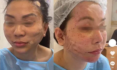 "Lạnh gáy" những pha cấy chỉ căng da của chị em trung niên, đẹp chưa thấy, ngắm đã xót