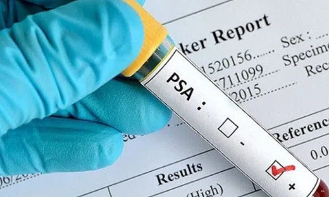 Xét nghiệm máu thấy chỉ số về ung thư bình thường chớ vội mừng: Bác sĩ lý giải "bí mật" ai cũng cần biết