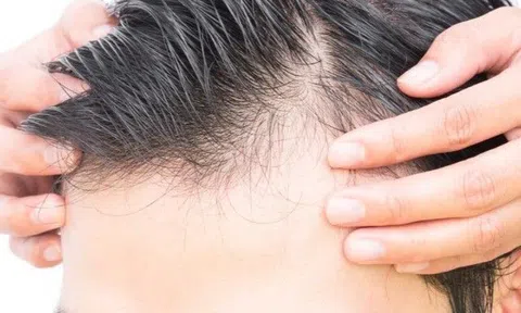 "Tự sướng" nhiều có thể gây hói đầu? Chuyên gia tình dục tiết lộ điều này mới đáng lo