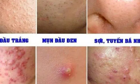 Hỗ trợ giảm mụn không qua đường uống trong thời gian ngắn