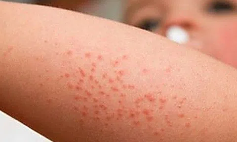 Cách phân biệt COVID-19, cúm và sốt xuất huyết