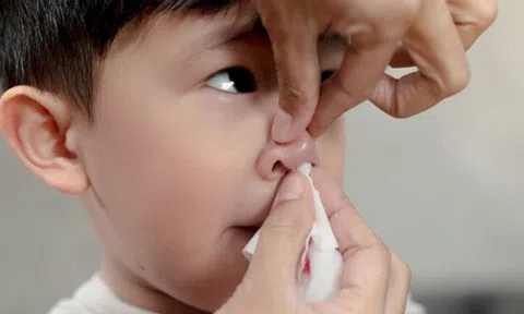 Thương cháu trai sổ mũi, bà mua thuốc về nhỏ cho, 2 tuần sau trẻ bị chảy máu mũi phải vào viện