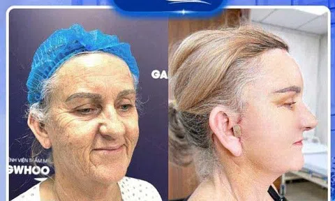 Hành trình nữ khách hàng ngoại quốc tìm lại tuổi xuân sau căng da mặt