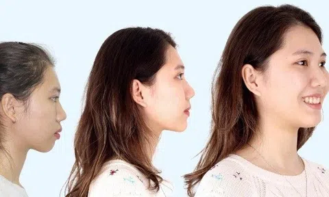 Niềng răng có làm thay đổi khuôn mặt đẹp hơn không?