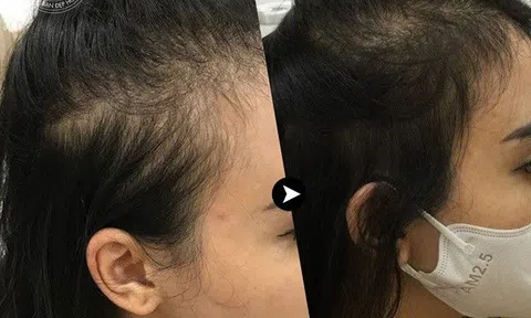 Spa Thu Linh: Dịch vụ cấy tóc công nghệ cao, không xâm lấn