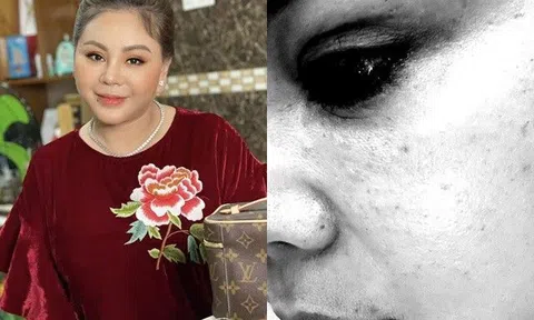 Lê Giang gặp tổn thương nặng buộc phải tạm ngưng công việc, nhìn vào mắt nhiều người sợ hãi