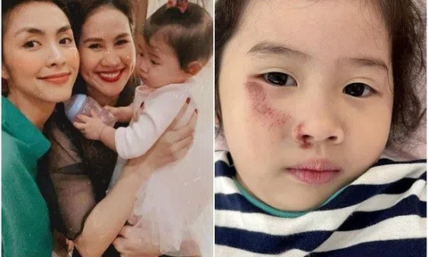 Con gái Thân Thúy Hà bị ngã xe trầy xước hết mặt mũi khiến Tăng Thanh Hà, Quang Dũng xót xa