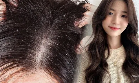 Gội đầu hàng ngày tóc vẫn không sạch, đây là 4 thói quen hội chị em liên tục gặp gàu và ngứa