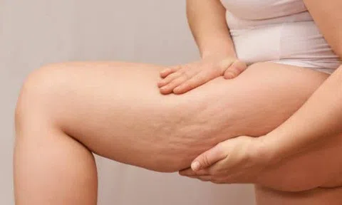 6 thực phẩm vạn người mê khiến da lồi lõm, sần vỏ cam vì mỡ tích chồng chất