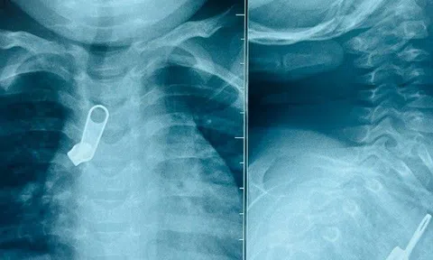 Tình cảnh bất ngờ khiến chiếc móc khóa "treo" trong ngực bé trai, người nhà cản không kịp