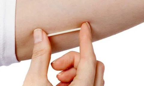Người phụ nữ Hà Nội phát hiện que cấy tránh thai "đi lạc chỗ", 2 điều ai cũng cần biết trước khi cấy que