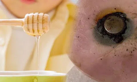 Tại sao mật ong có thể cứu sống trẻ nếu nuốt phải pin cúc áo? Đoạn video của nhân viên y tế tiết lộ sự thật