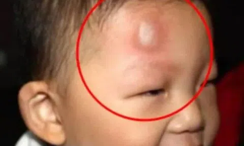 Con ngã từ trên giường xuống đất trán sưng to như quả ổi, mẹ trơ mắt đứng nhìn khiến bà nội tức giận nhưng BS khen