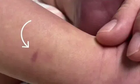 Con nổi ban đỏ như vết bầm ở chân, mẹ làm một việc nhỏ liền phát hiện ra ngay con đang gặp nguy hiểm