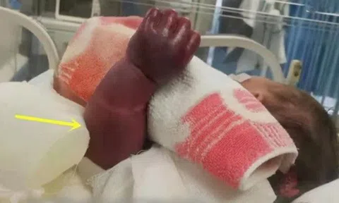 Bé trai 1 tháng khóc thét, phải bỏ cánh tay sưng tím như quả cà vì hành động yêu cháu quá đà của bà nội