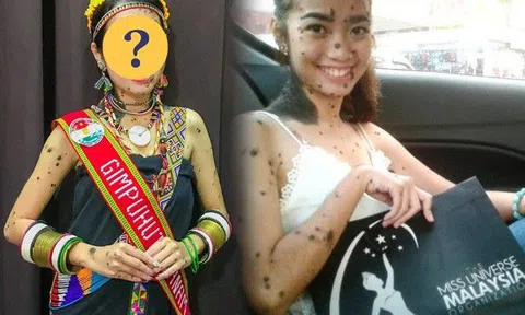 Cô gái có nốt ruồi mọc chi chít khắp cơ thể từng đi thi Hoa hậu, sau 6 năm giờ ra sao?